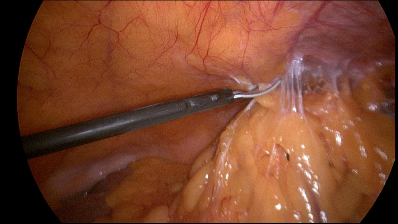Omental Adhesiolysis HT2 Omental Adhesiolysis HT2